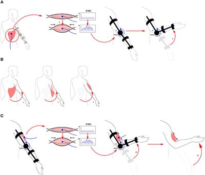 Perspectives for the Use of Neurotechnologies in Conjunction With Muscle Autotransplantation in Children